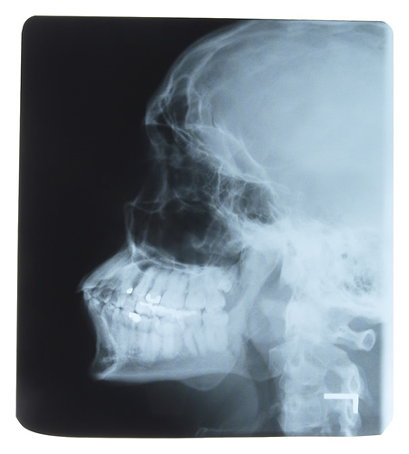 skull